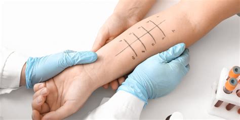 scratch test allergy cost|allergy scratch testing 14 allergens.